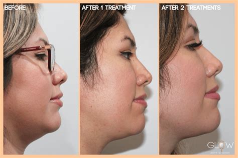 kybella pris|Kybella: Cost, Side Effects, and What to Expect .